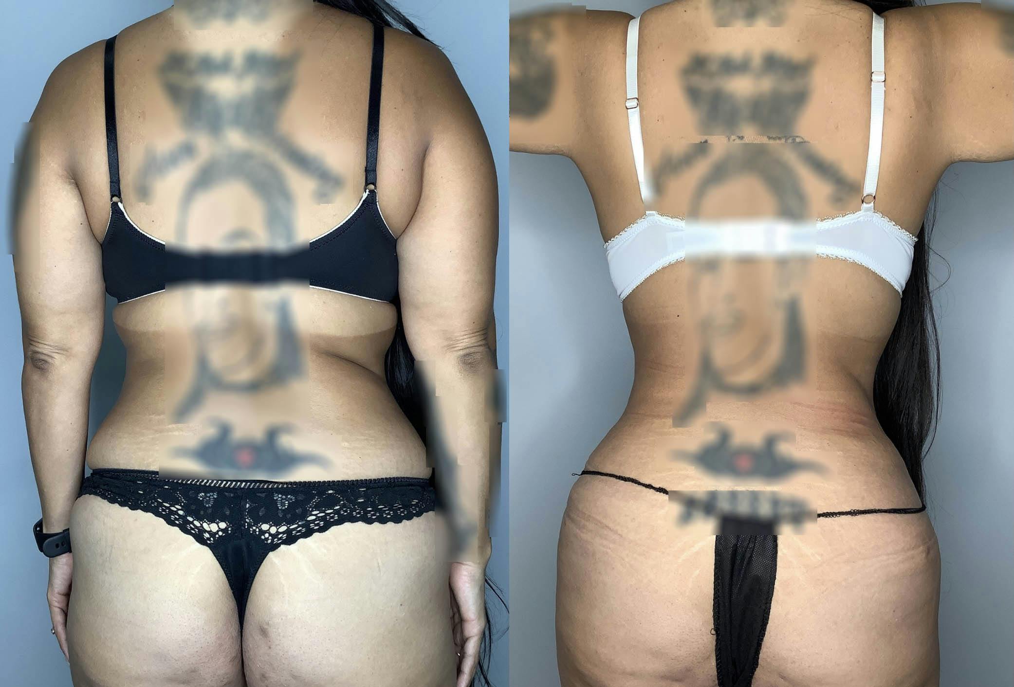 Liposuction Before & After Gallery - Patient 74007243 - Image 4