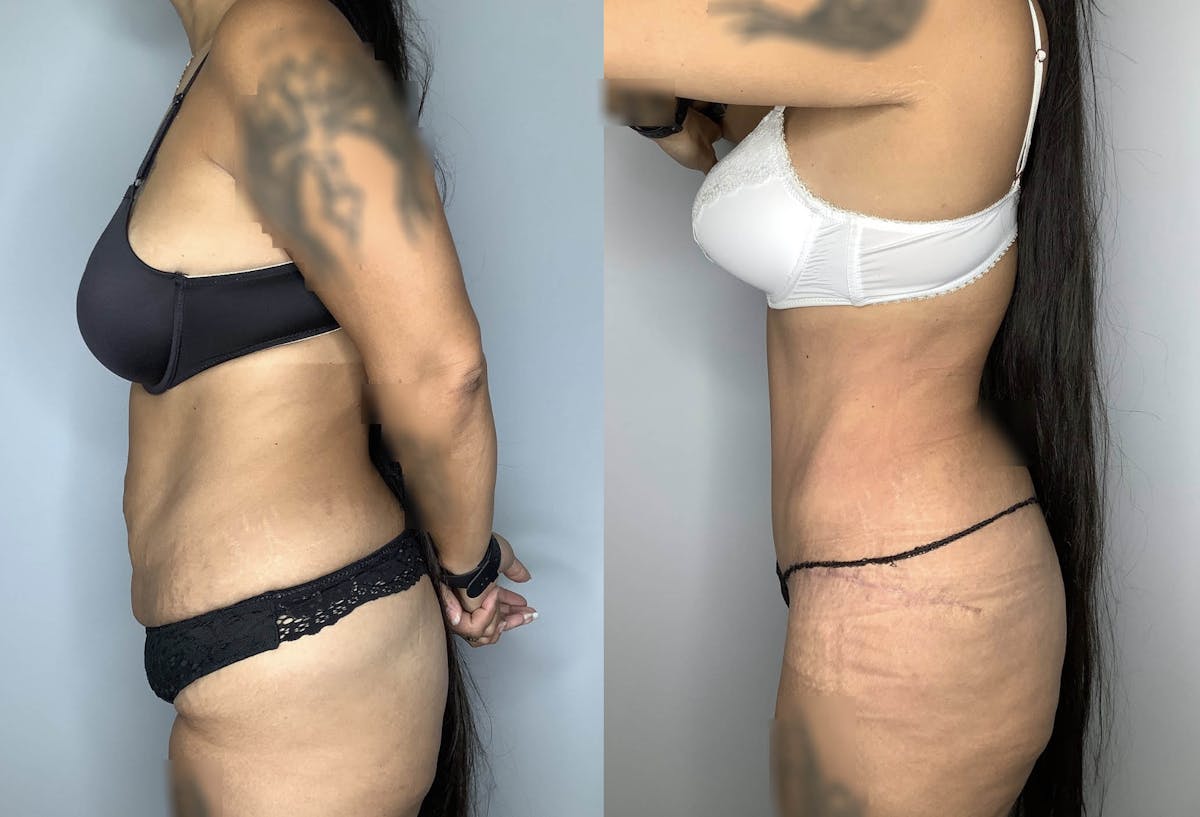 Liposuction Before & After Gallery - Patient 74007243 - Image 3
