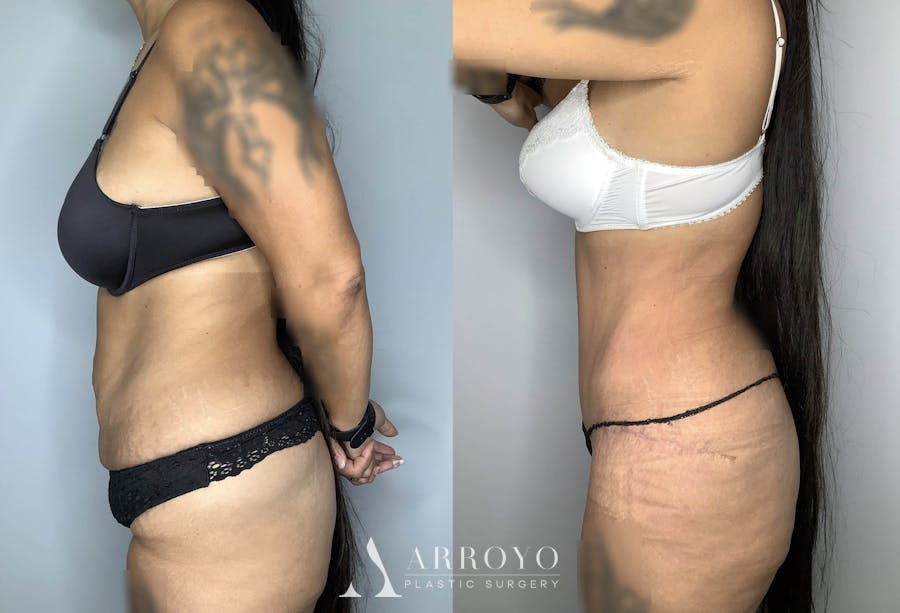 Tummy Tuck Before & After Gallery - Patient 74007230 - Image 5