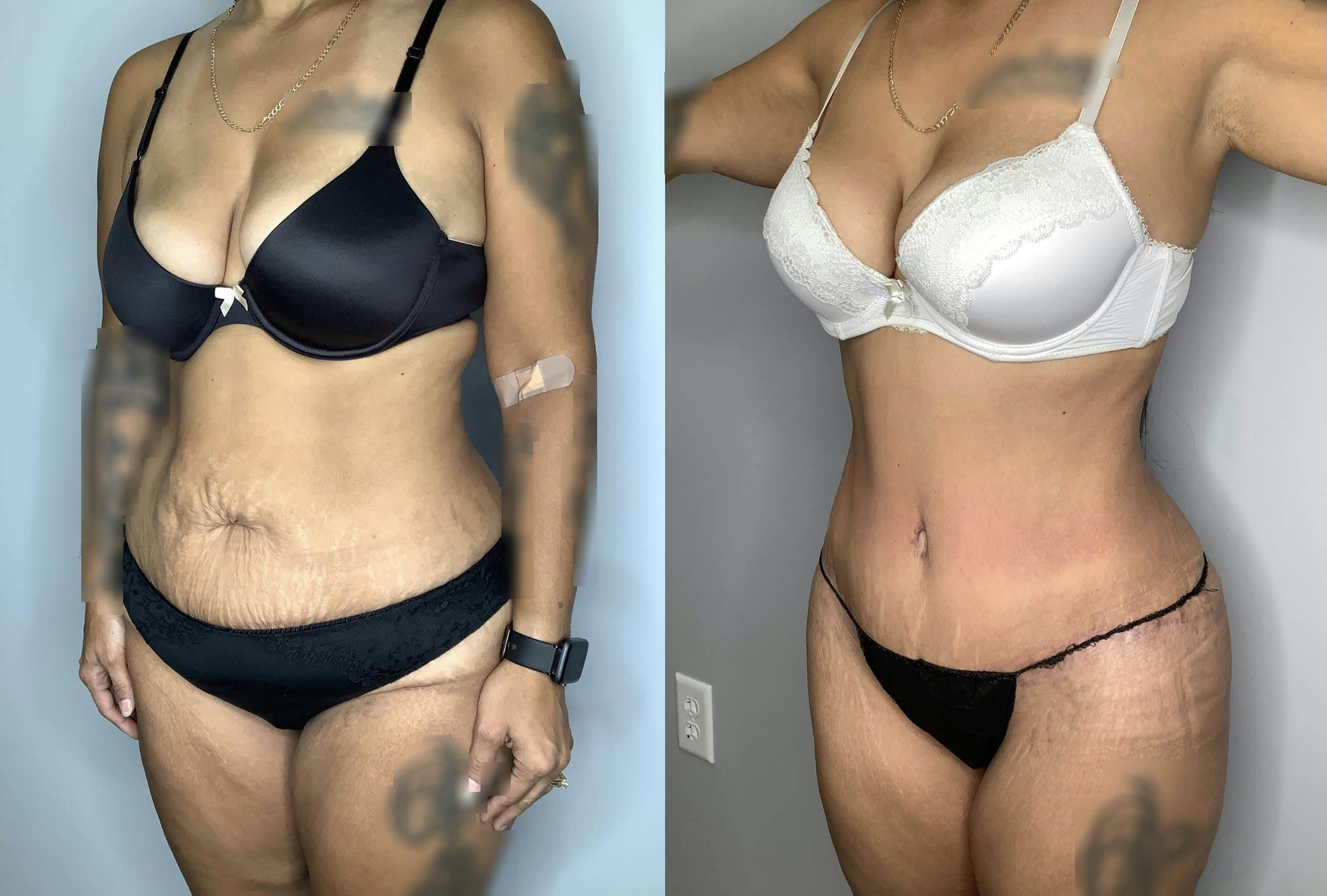 Tummy Tuck Before & After Gallery - Patient 74007230 - Image 6