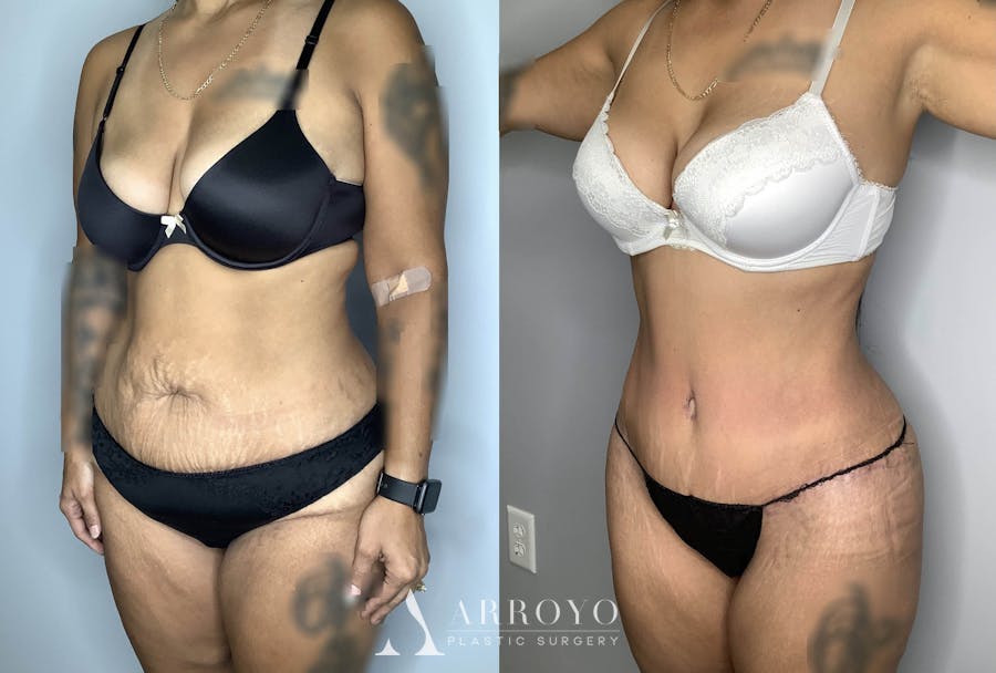 Tummy Tuck Before & After Gallery - Patient 74007230 - Image 6