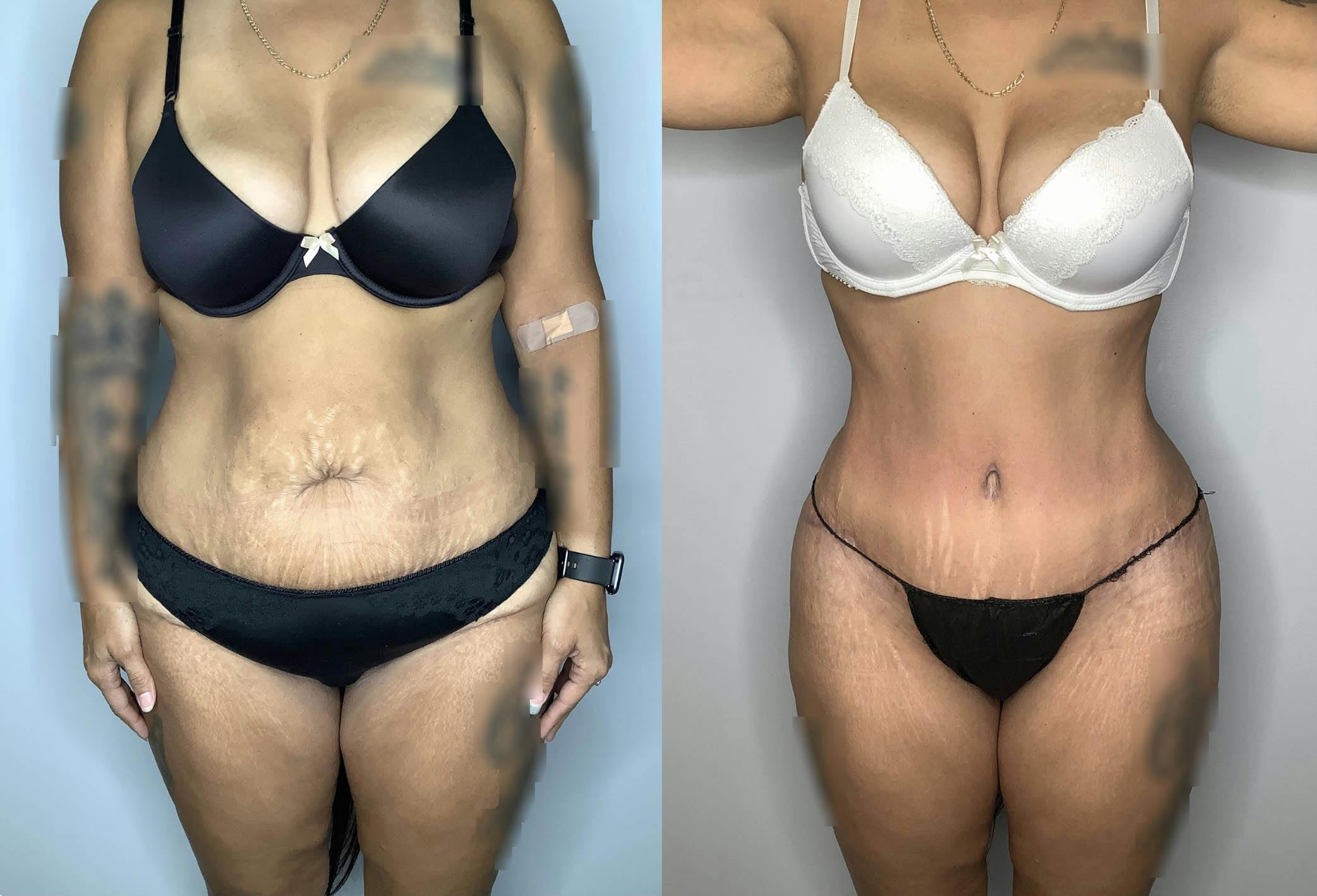 Liposuction Gallery - Patient 74007243 - Image 1