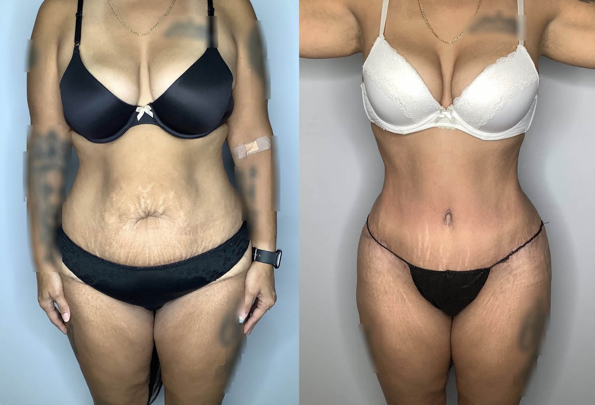 Tummy Tuck Before & After Gallery - Patient 74007230 - Image 1