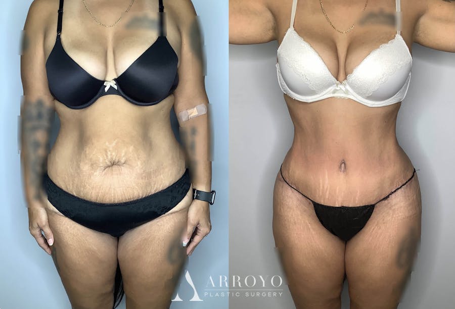 Tummy Tuck Before & After Gallery - Patient 74007230 - Image 1
