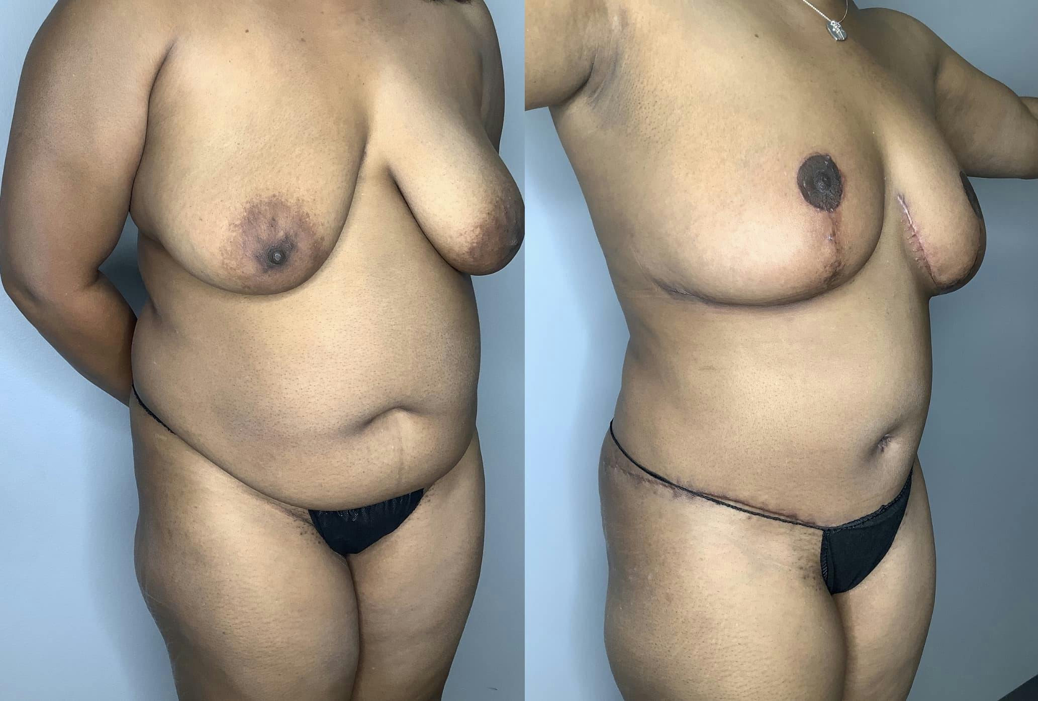 Tummy Tuck Gallery - Patient 85898132 - Image 2