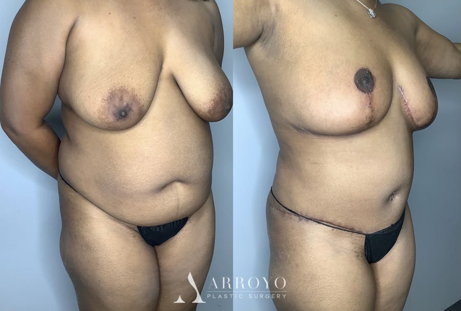 Tummy Tuck Before & After Gallery - Patient 85898132 - Image 2