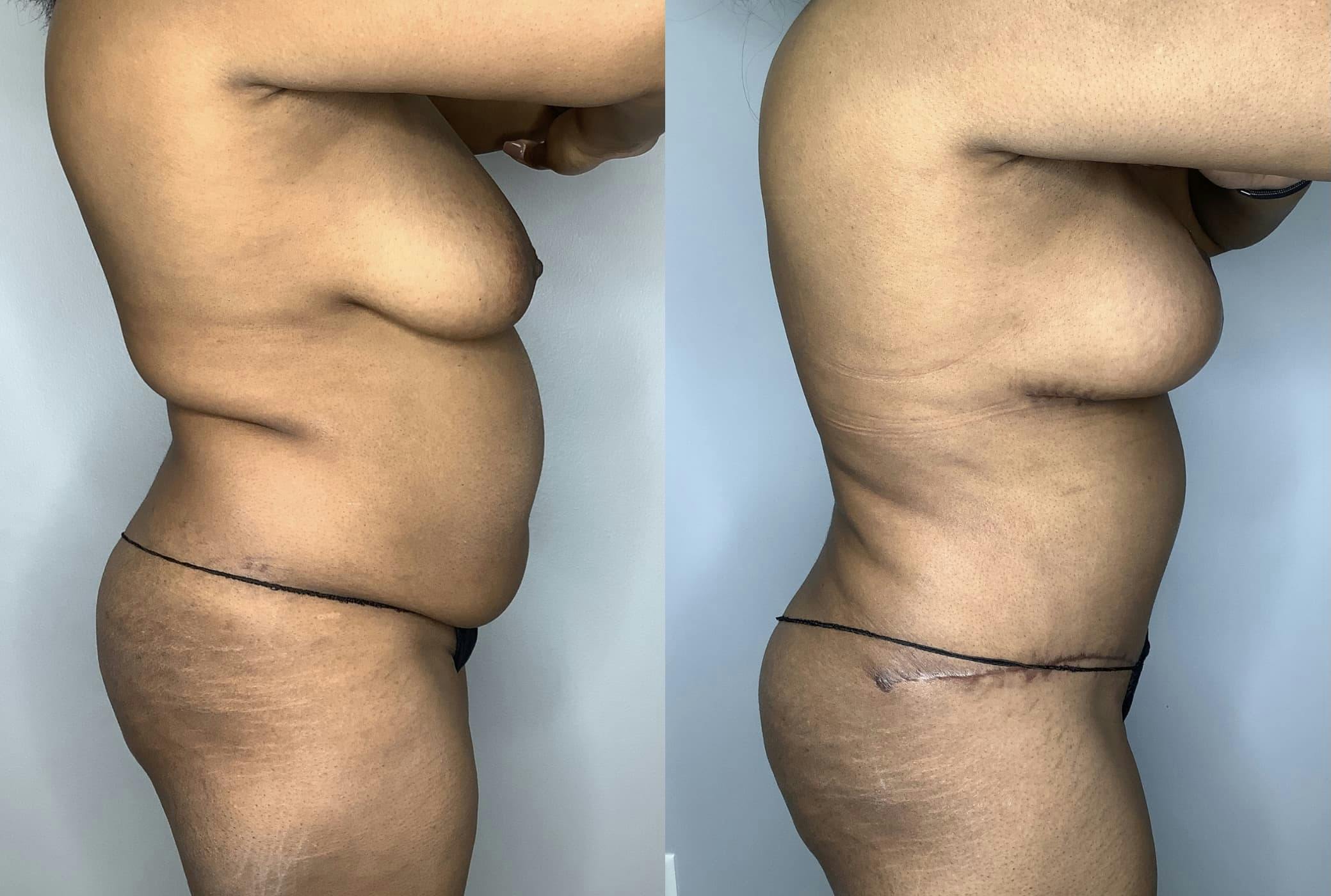 Breast Lift Before & After Gallery - Patient 85898138 - Image 4