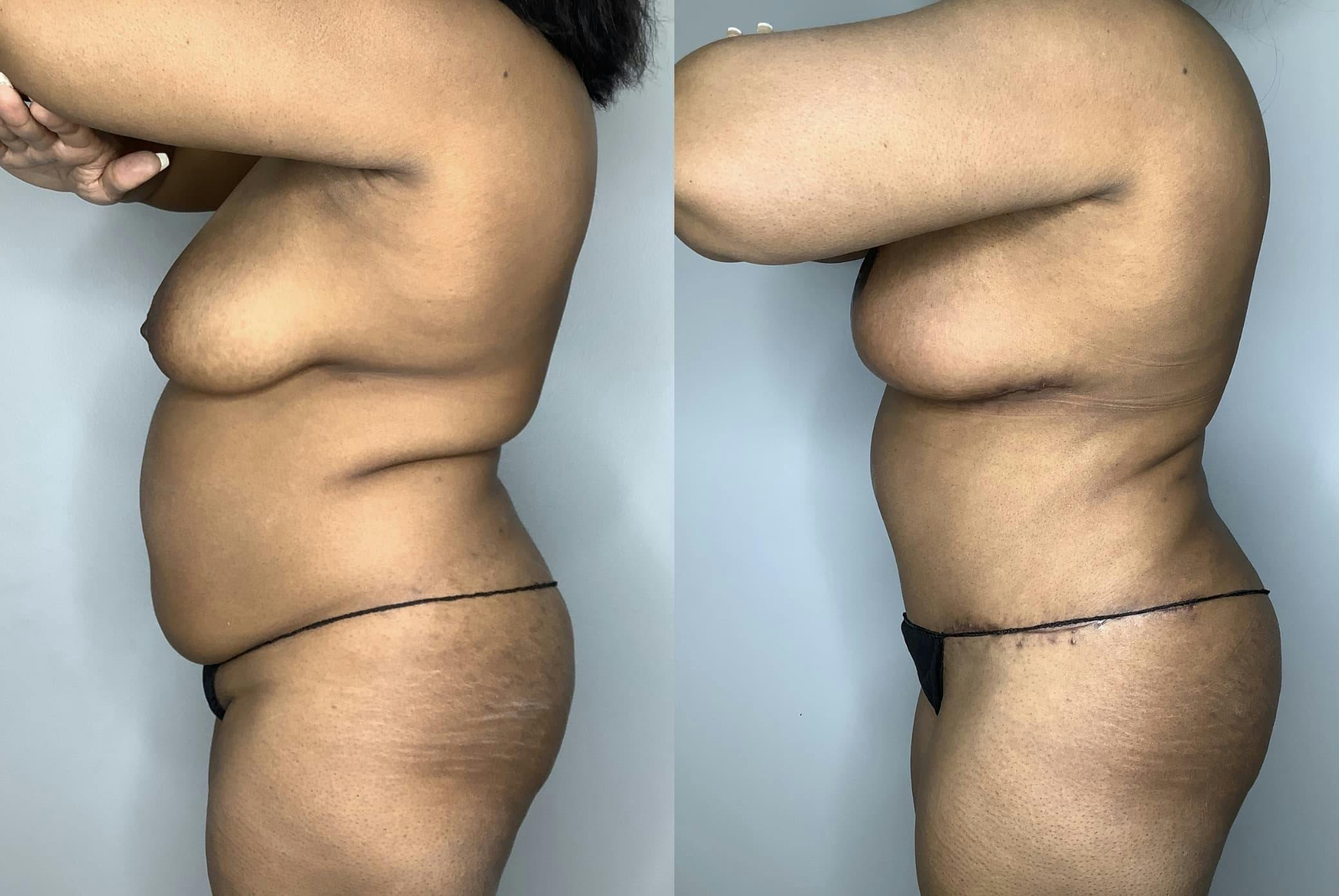 Tummy Tuck Before & After Gallery - Patient 85898132 - Image 4