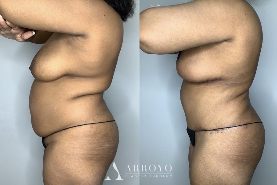 Tummy Tuck Before & After Gallery - Patient 85898132 - Image 4