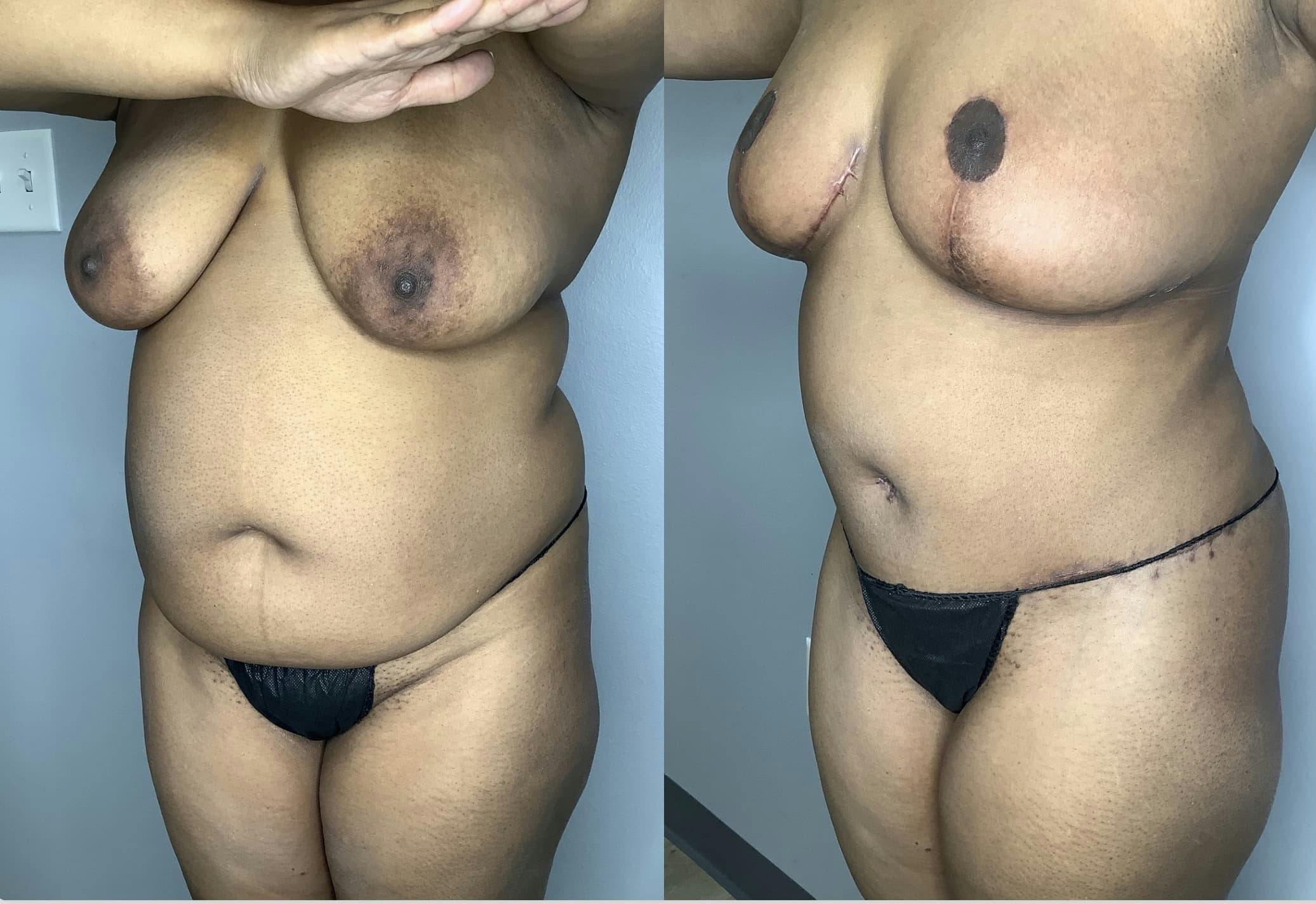 Tummy Tuck Gallery - Patient 85898132 - Image 5
