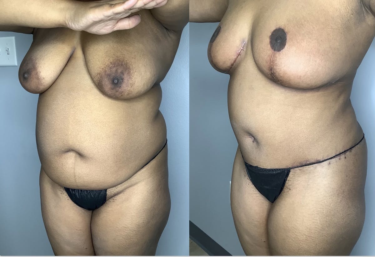 Tummy Tuck Before & After Gallery - Patient 85898132 - Image 5