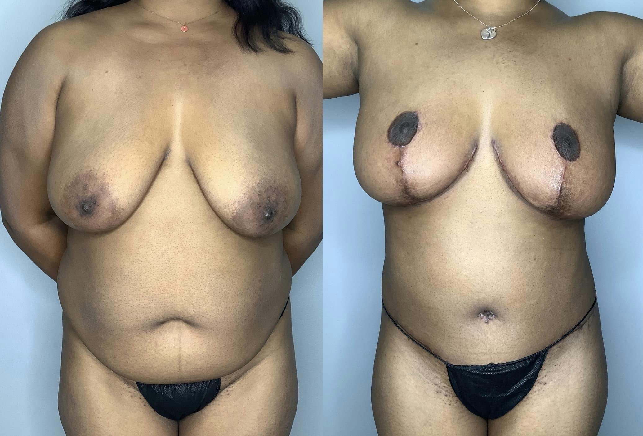 Breast Lift Gallery - Patient 85898138 - Image 1