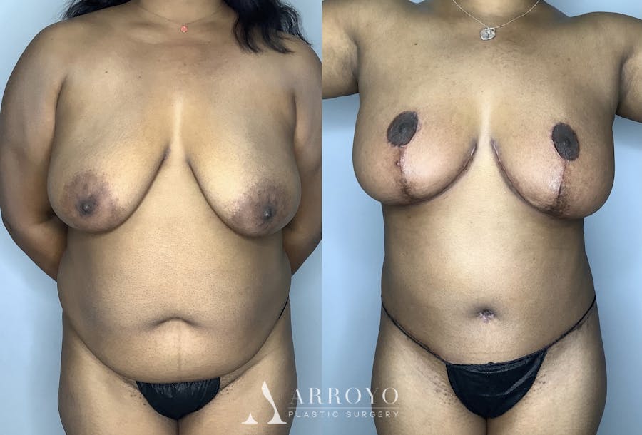 Tummy Tuck Before & After Gallery - Patient 85898132 - Image 1