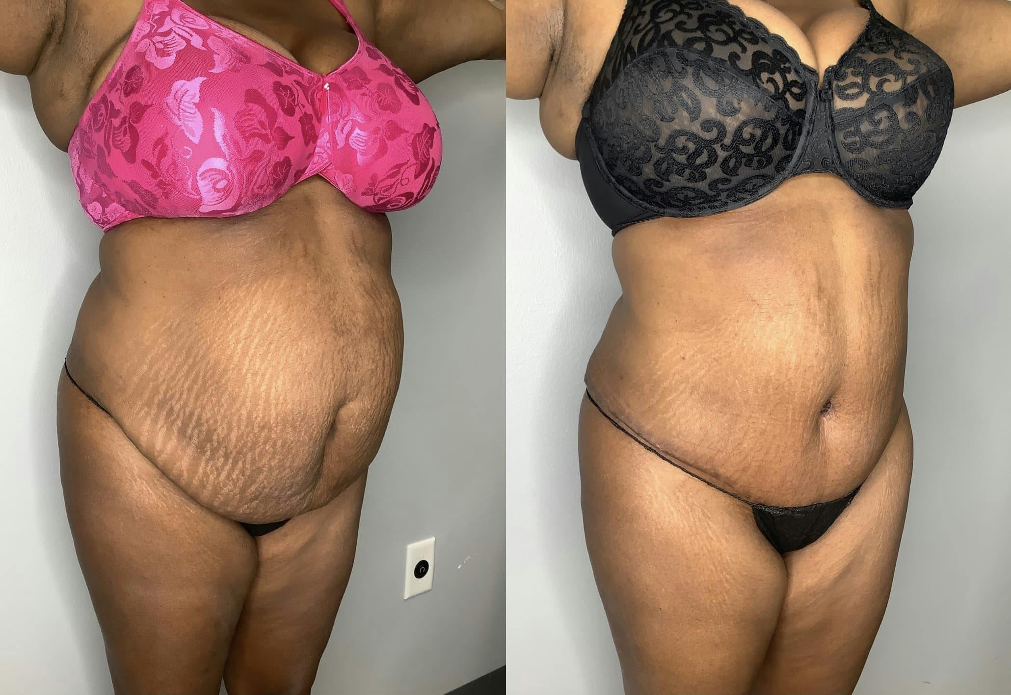 Liposuction Before & After Gallery - Patient 90451966 - Image 1