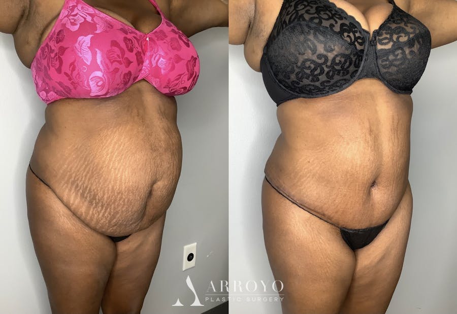 Tummy Tuck Before & After Gallery - Patient 90451963 - Image 1
