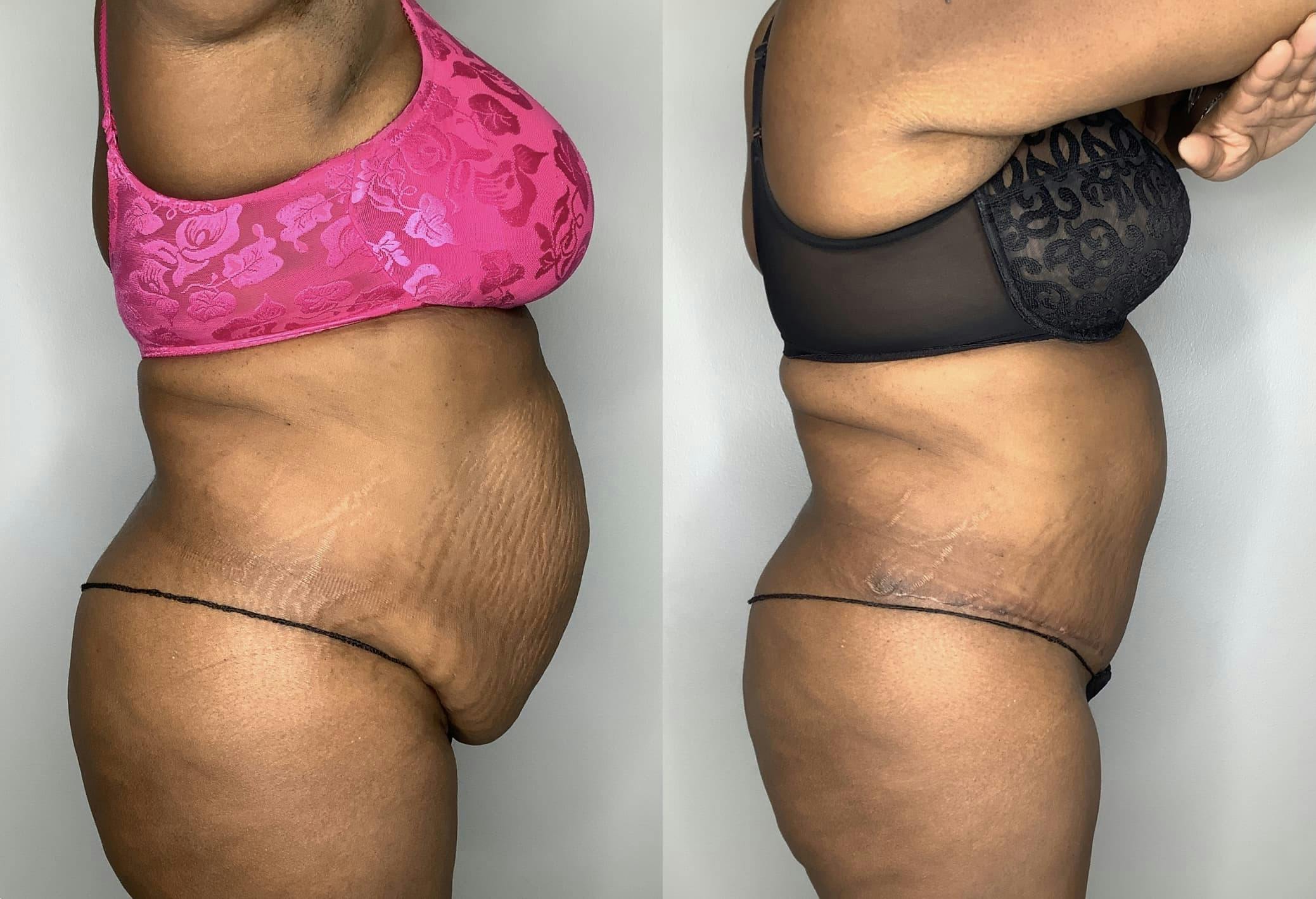 Tummy Tuck Before & After Gallery - Patient 90451963 - Image 2