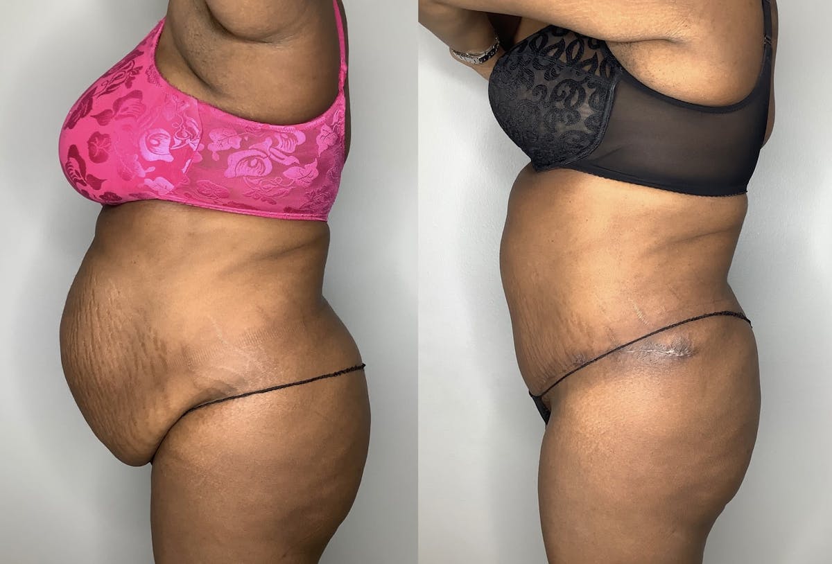 Tummy Tuck Before & After Gallery - Patient 90451963 - Image 3