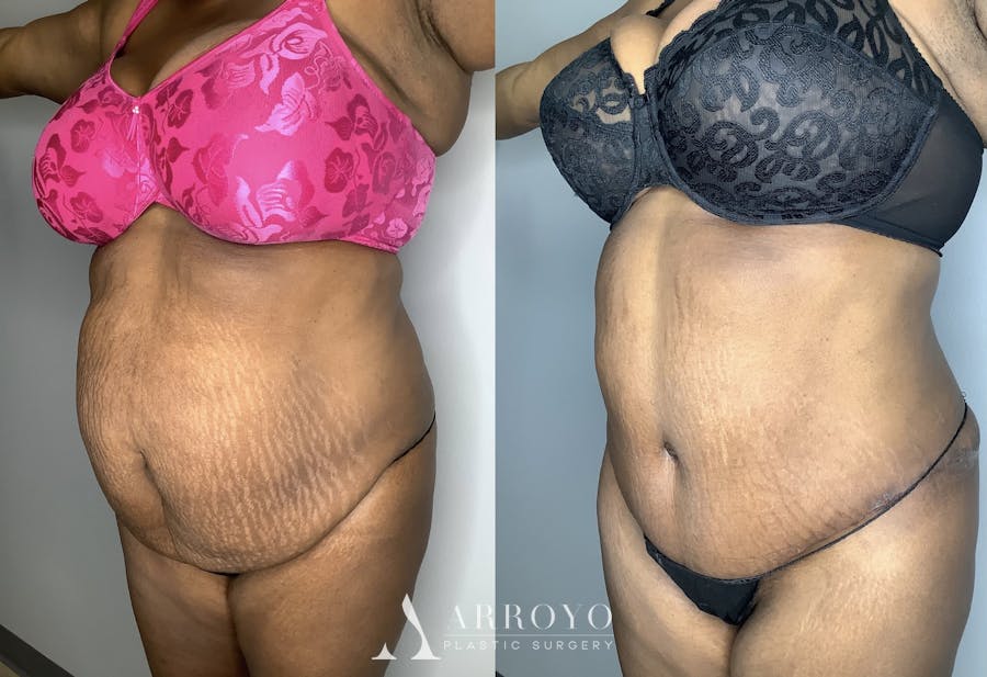 Tummy Tuck Before & After Gallery - Patient 90451963 - Image 4