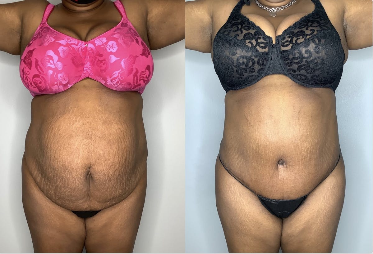Tummy Tuck Before & After Gallery - Patient 90451963 - Image 5