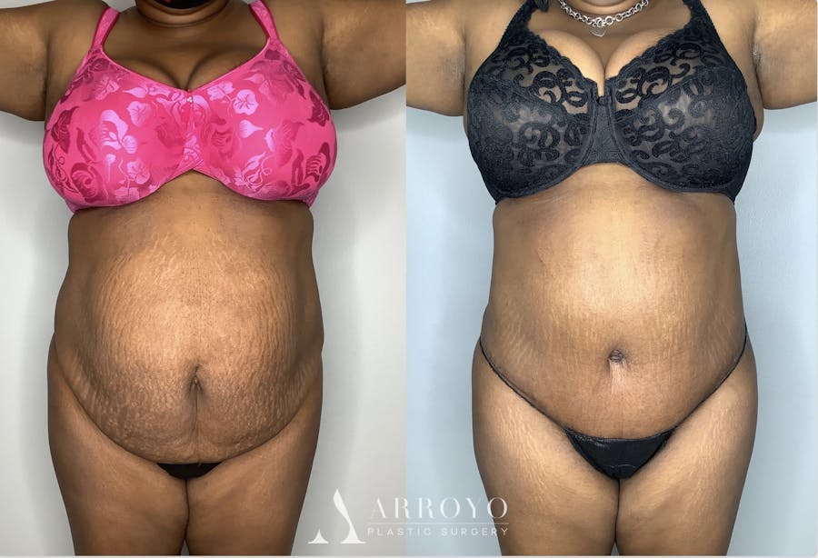 Tummy Tuck Before & After Gallery - Patient 90451963 - Image 5
