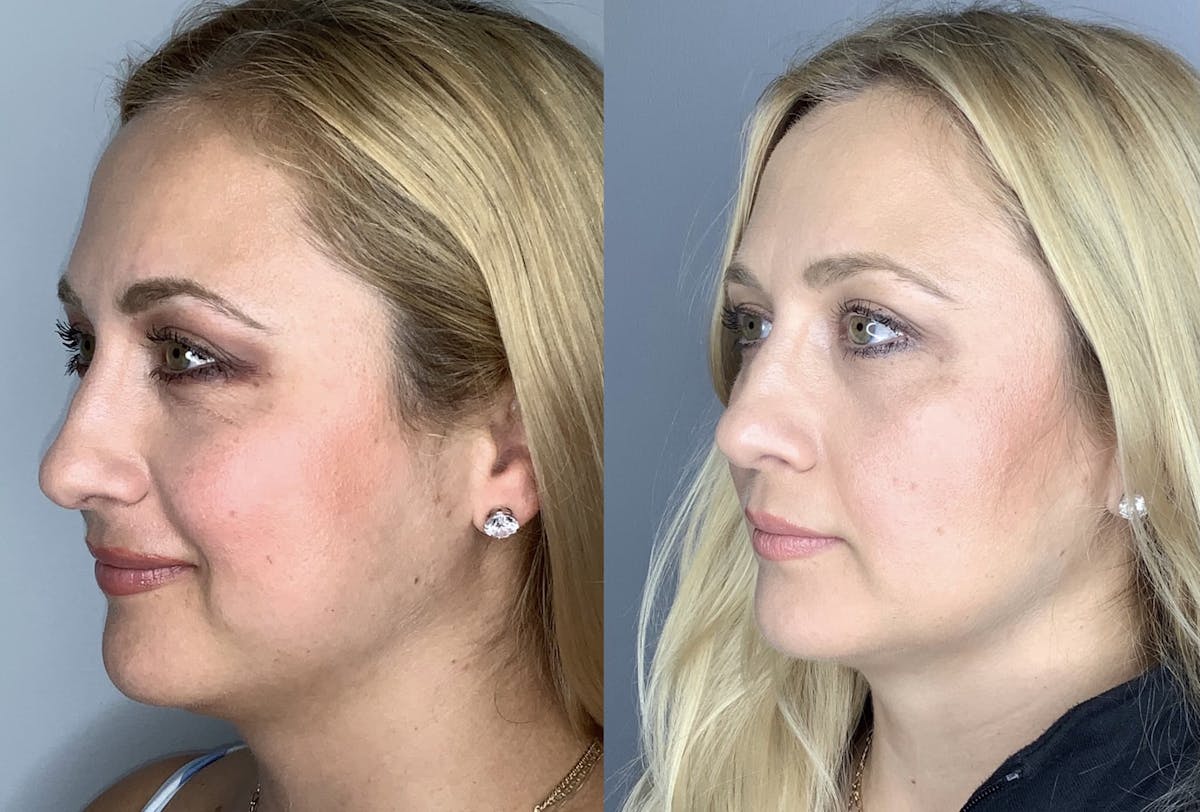 Buccal Fat Removal Before & After Gallery - Patient 90451969 - Image 2