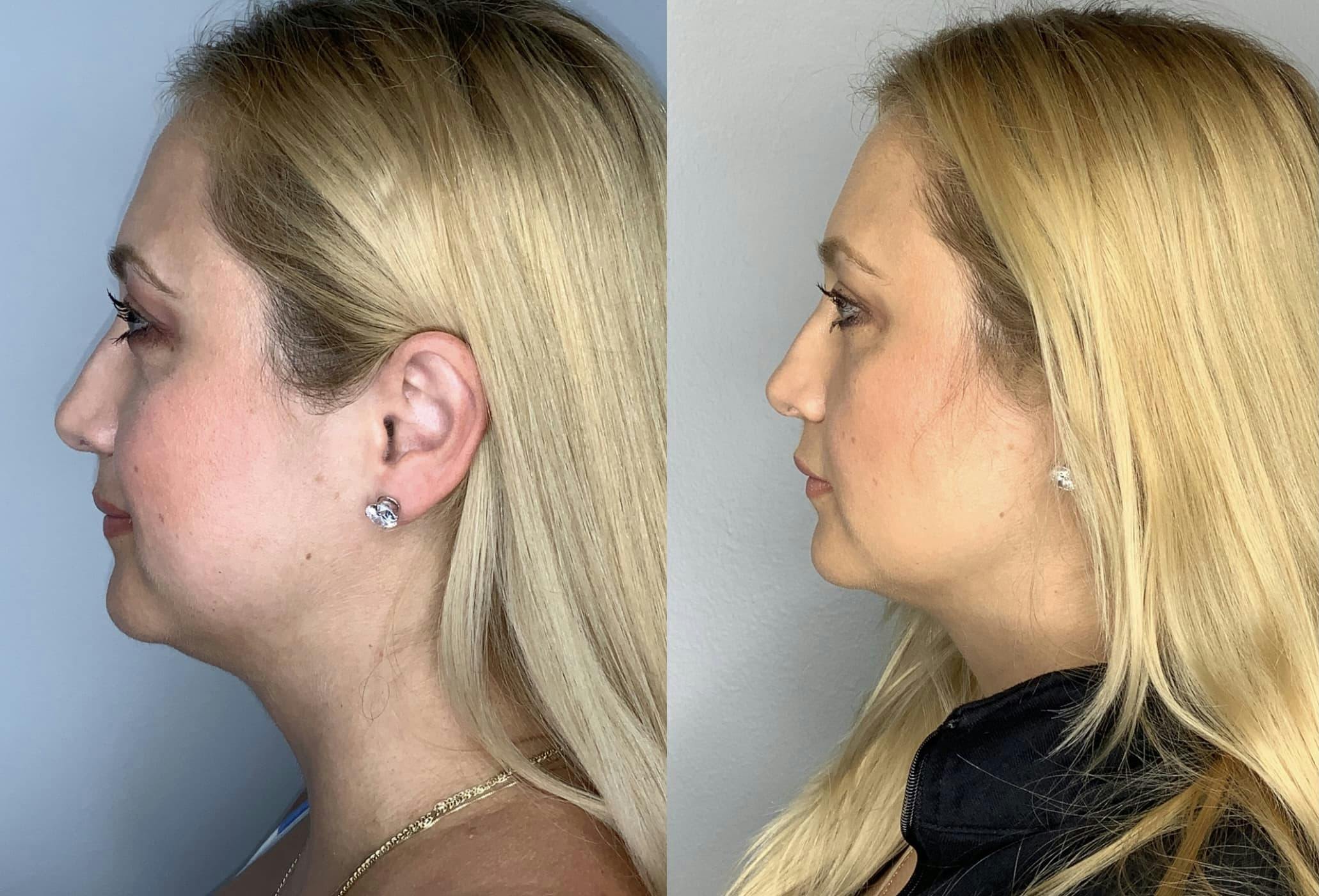 Buccal Fat Removal Before & After Gallery - Patient 90451969 - Image 3