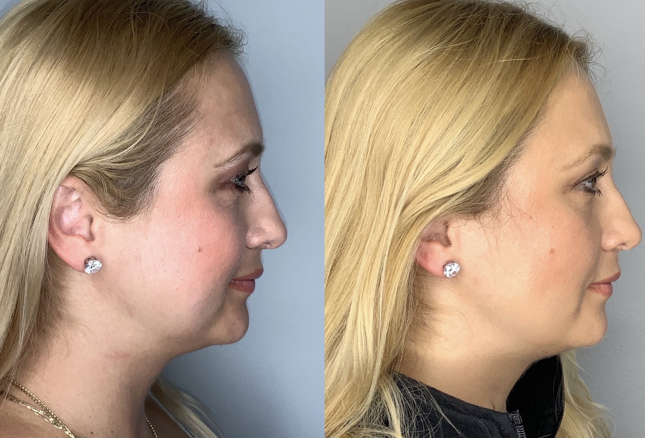 Buccal Fat Removal Before & After Photos | Arroyo Plastic Surgery