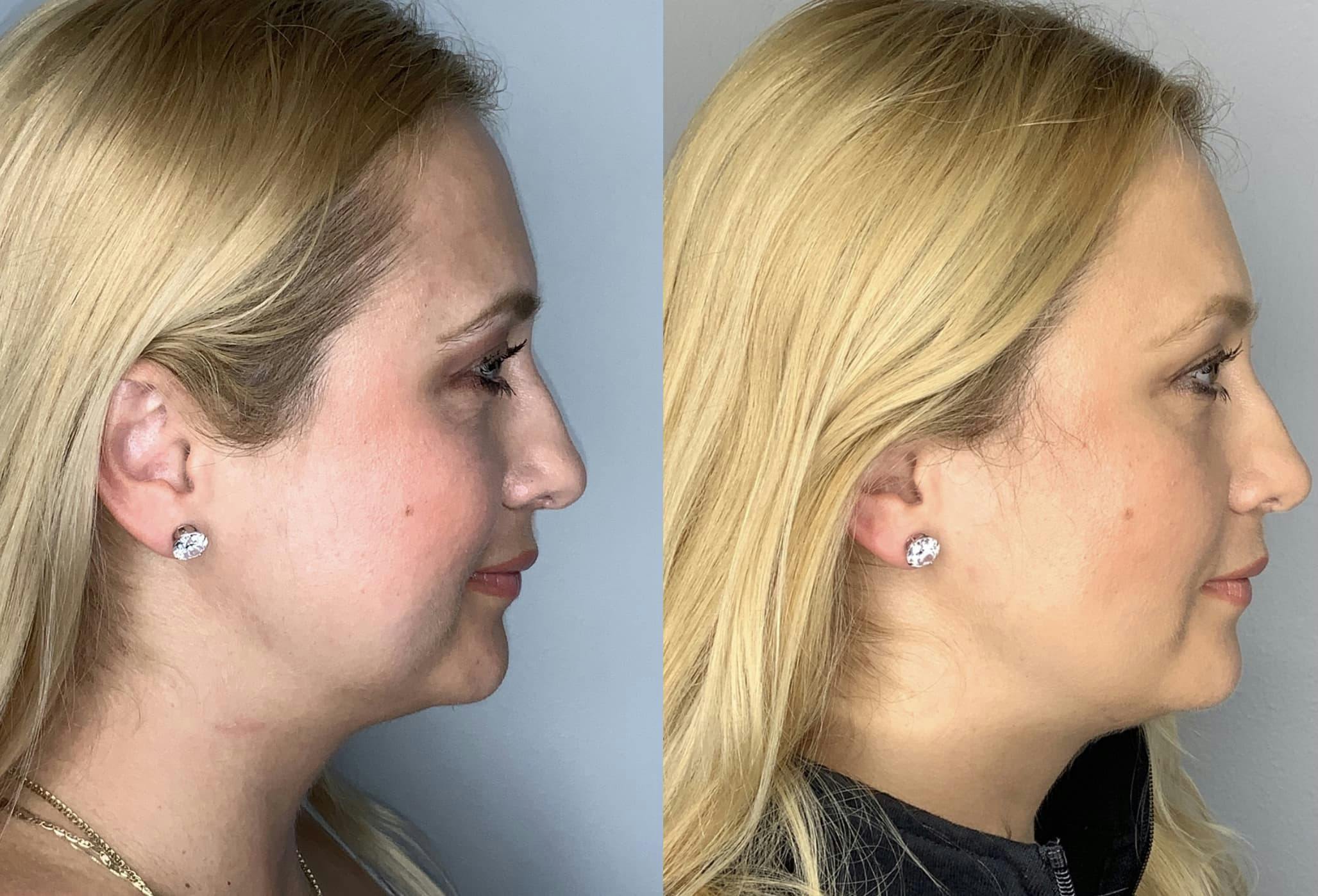 Buccal Fat Removal Before & After Gallery - Patient 90451969 - Image 4