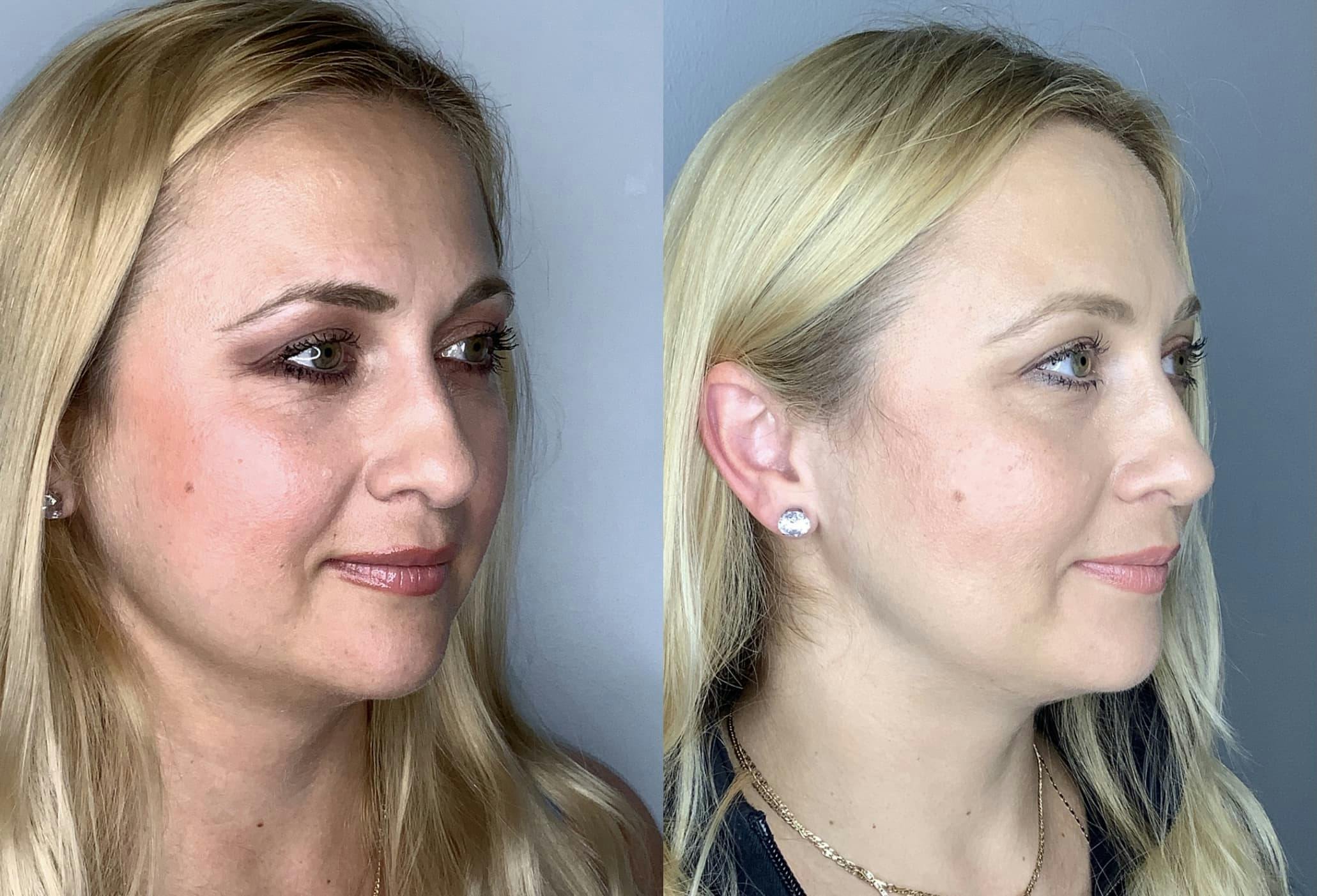 Buccal Fat Removal Before & After Gallery - Patient 90451969 - Image 5