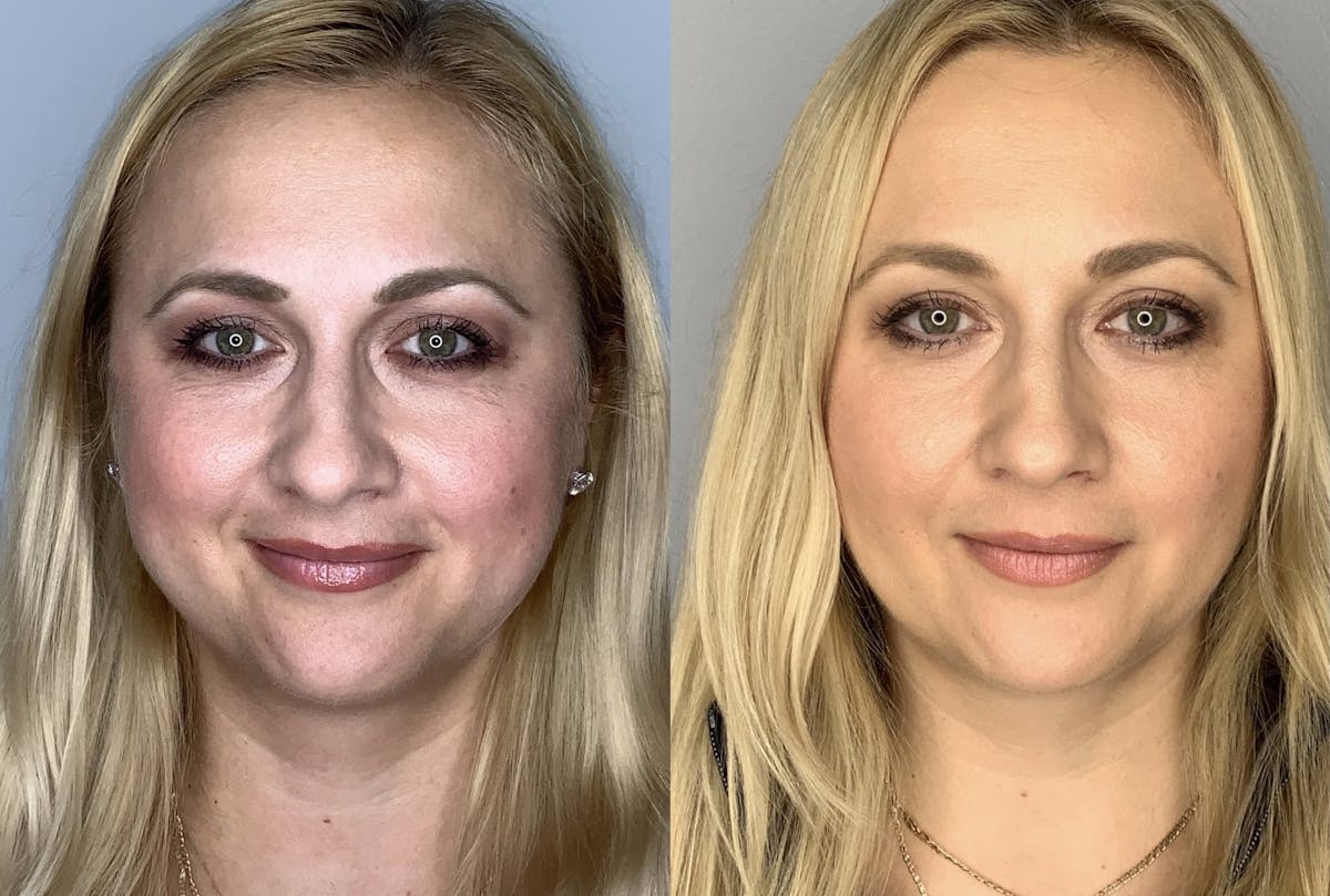 Buccal Fat Removal Before & After Gallery - Patient 90451969 - Image 1