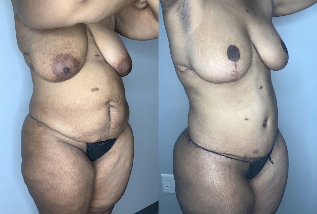 Breast Reduction Before & After Gallery - Patient 90451972 - Image 2