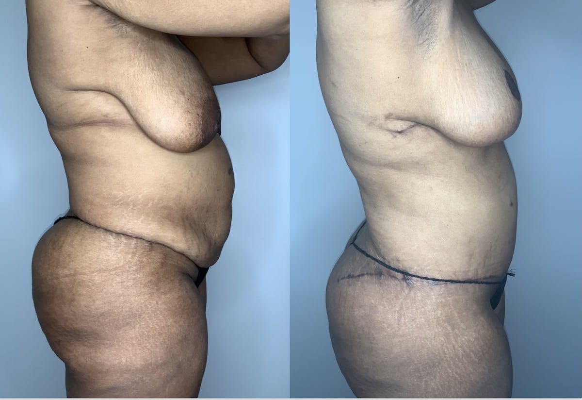 Breast Reduction Before & After Gallery - Patient 90451972 - Image 3