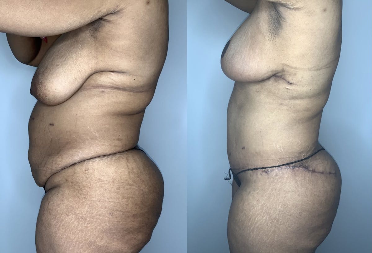 Breast Reduction Before & After Gallery - Patient 90451972 - Image 4