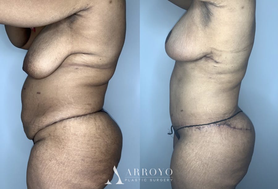 Tummy Tuck Before & After Gallery - Patient 90451985 - Image 3