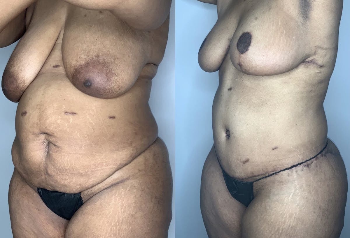 Tummy Tuck Before & After Gallery - Patient 90451985 - Image 2