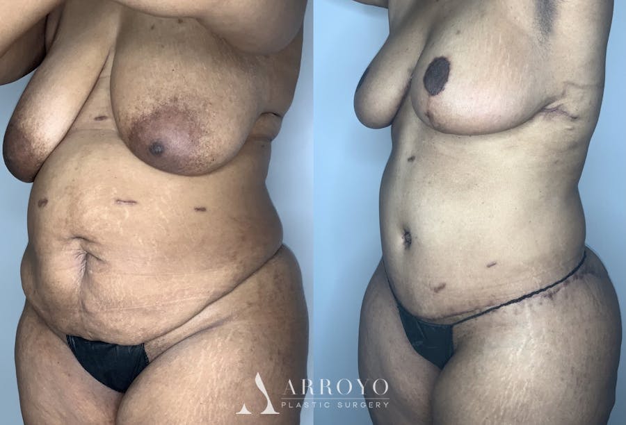 Tummy Tuck Before & After Gallery - Patient 90451985 - Image 2