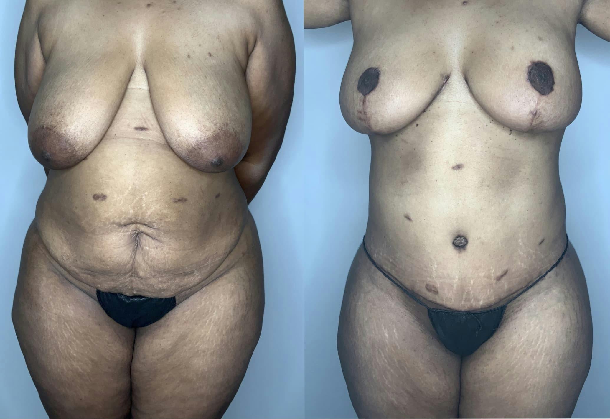 Liposuction Gallery - Patient 90451986 - Image 1