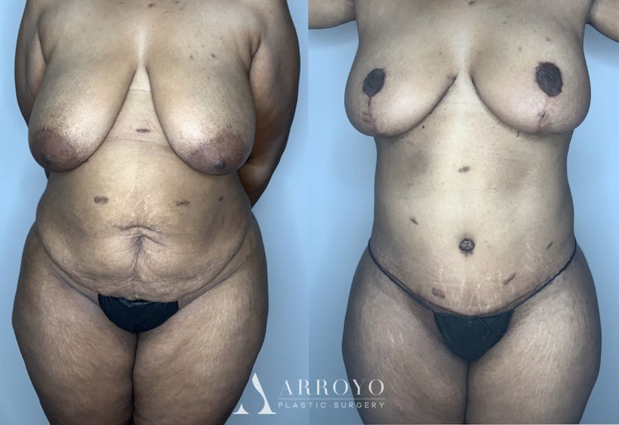Tummy Tuck Before & After Gallery - Patient 90451985 - Image 1