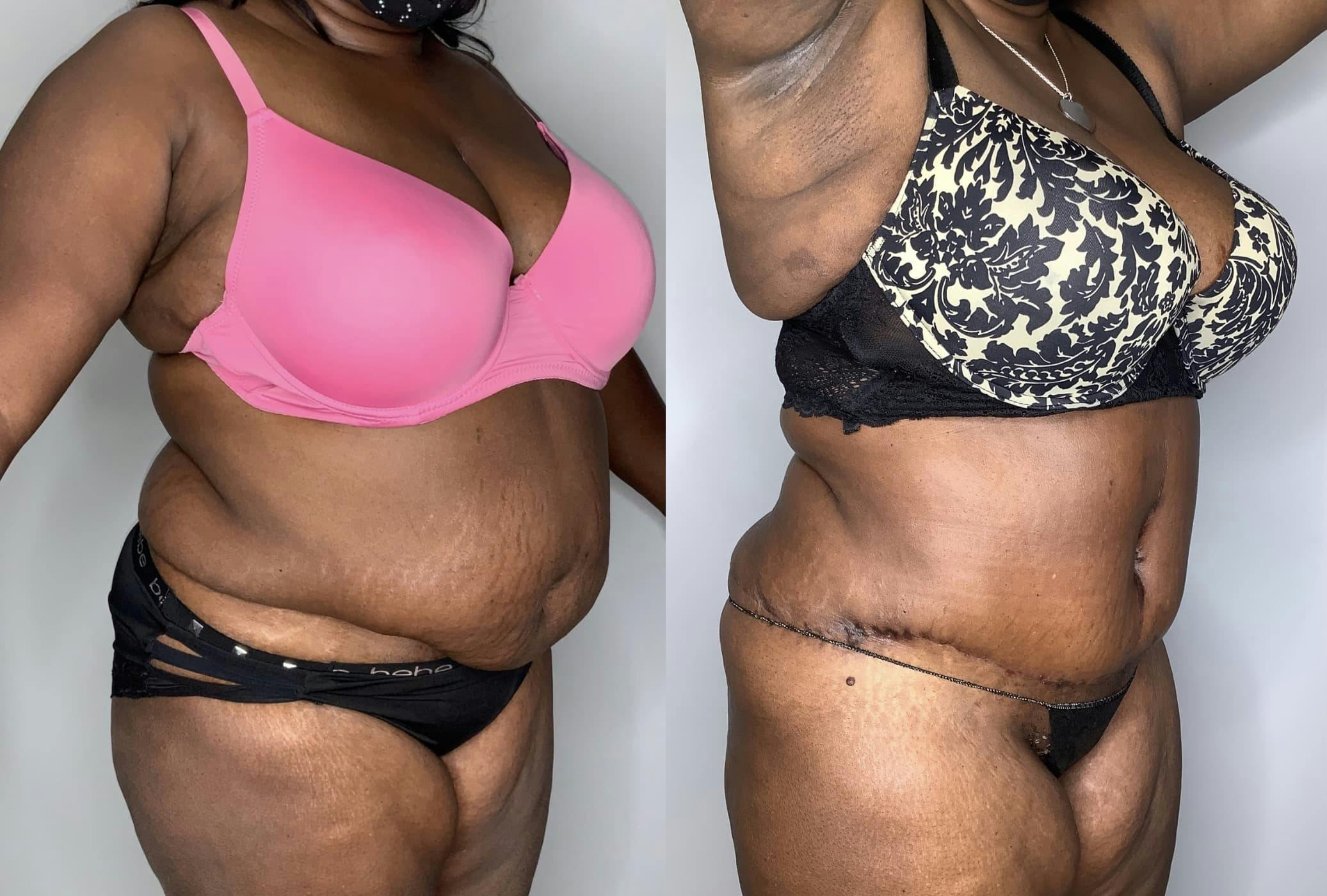 Tummy Tuck Before & After Gallery - Patient 90451989 - Image 2