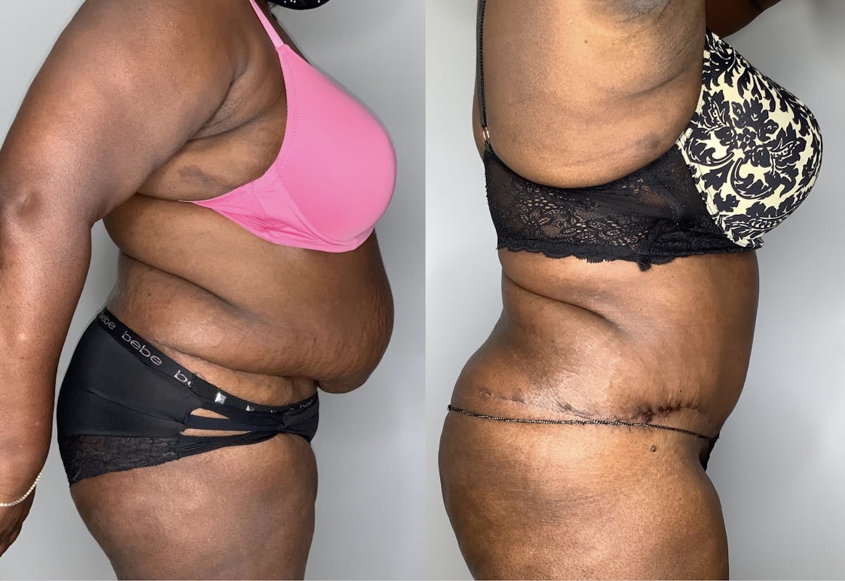 Tummy Tuck Before & After Gallery - Patient 90451989 - Image 3