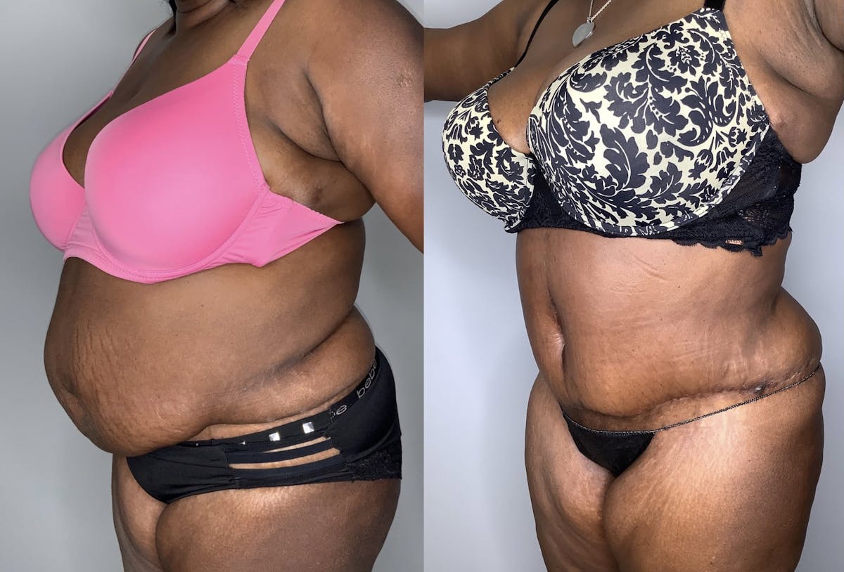 Liposuction Before & After Gallery - Patient 90451988 - Image 4