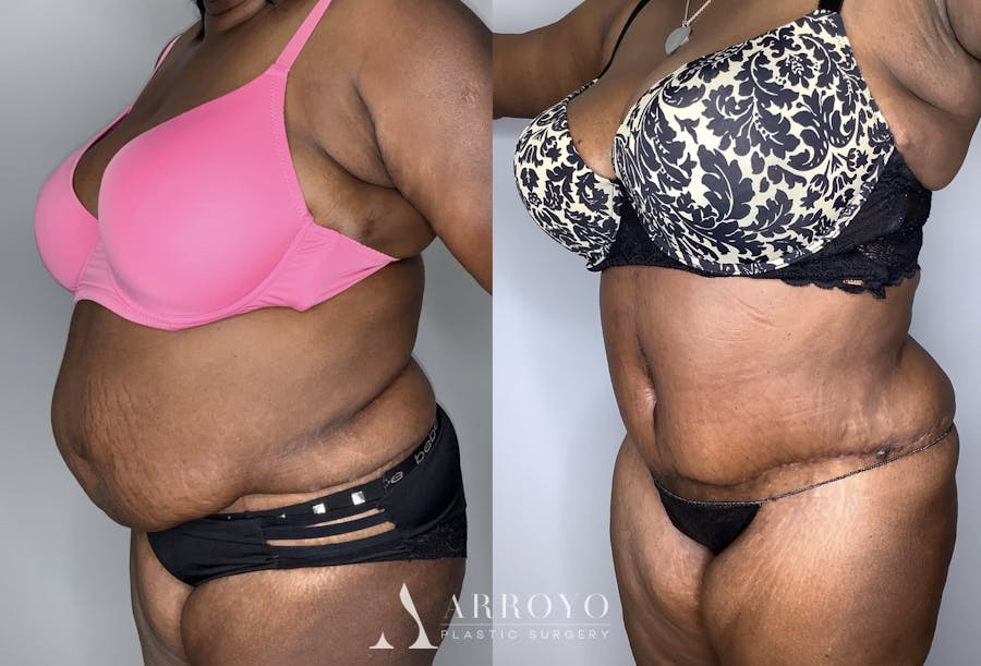 Tummy Tuck Before & After Gallery - Patient 90451989 - Image 5