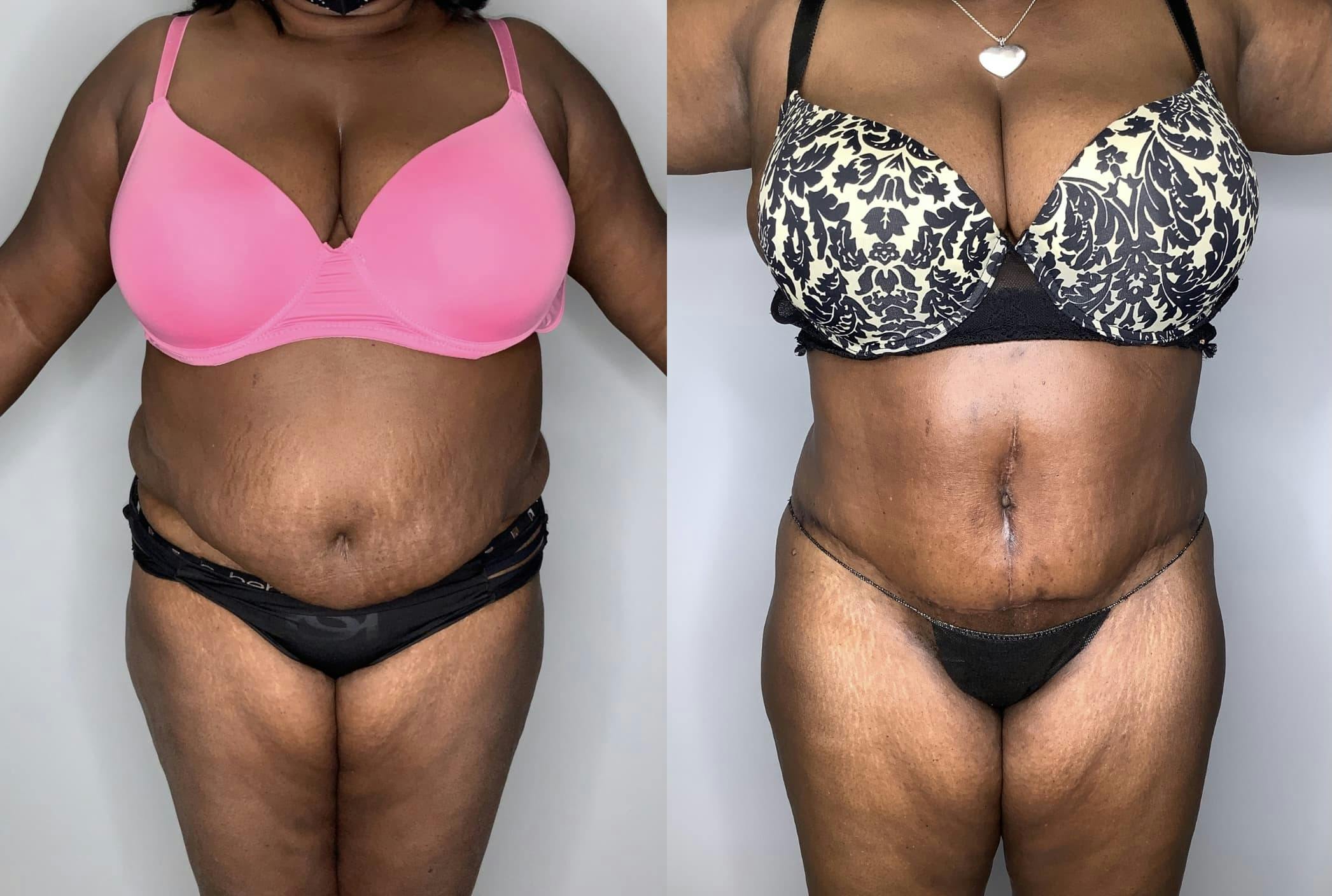 Liposuction Before & After Gallery - Patient 90451988 - Image 1