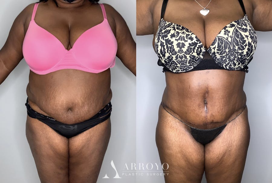 Tummy Tuck Before & After Gallery - Patient 90451989 - Image 1