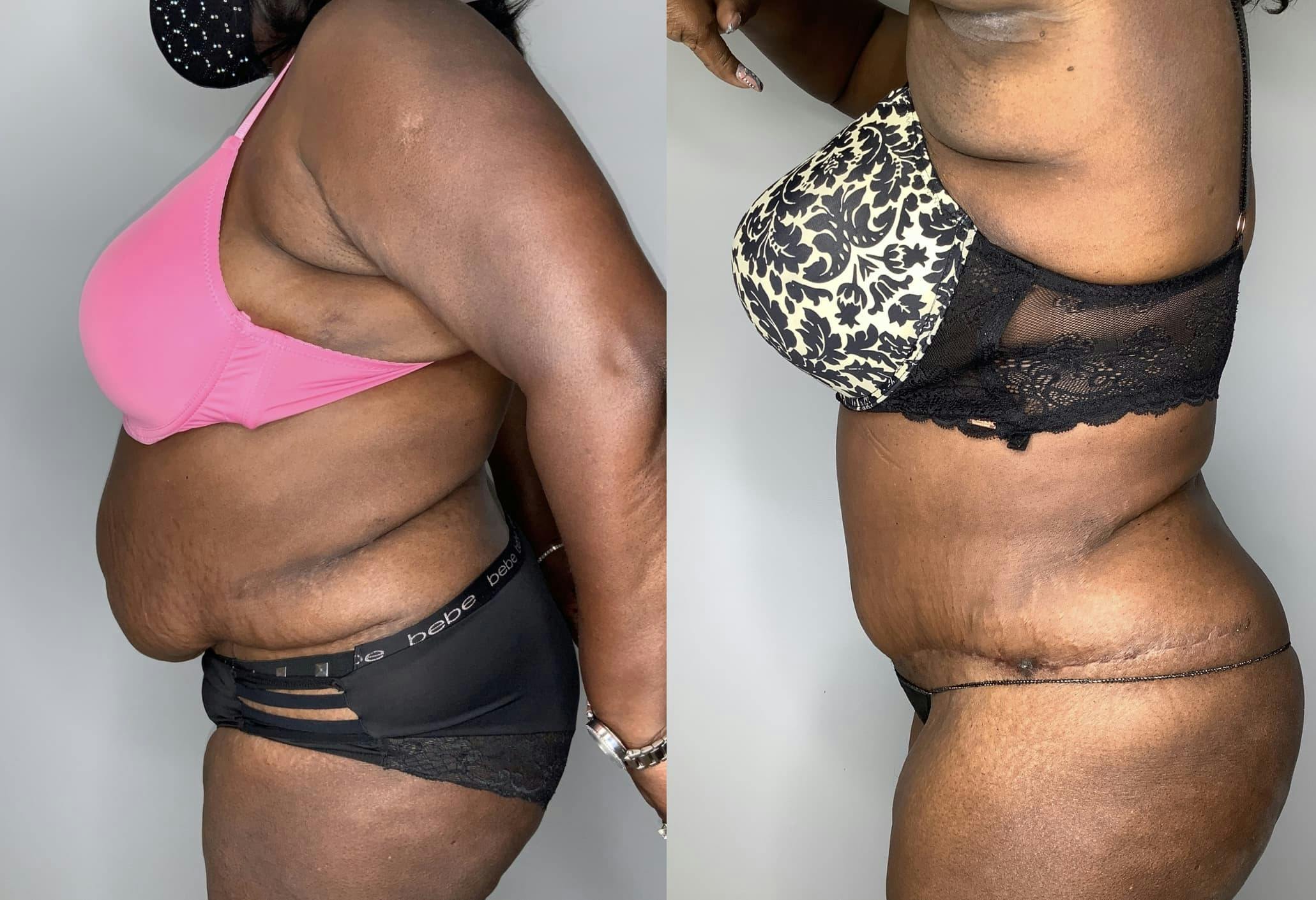 Tummy Tuck Before & After Gallery - Patient 90451989 - Image 4