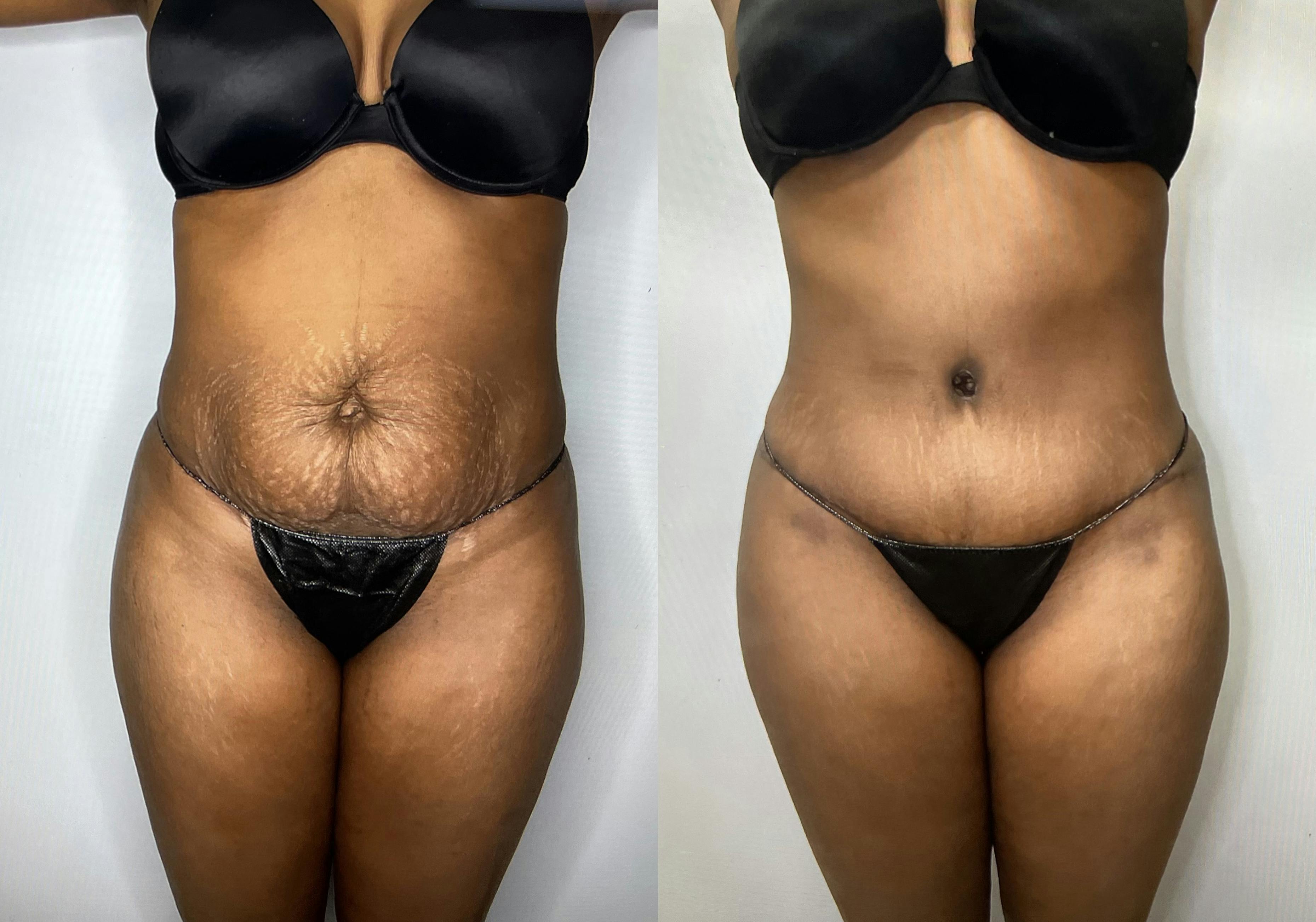 Before and After Liposuction in Houston