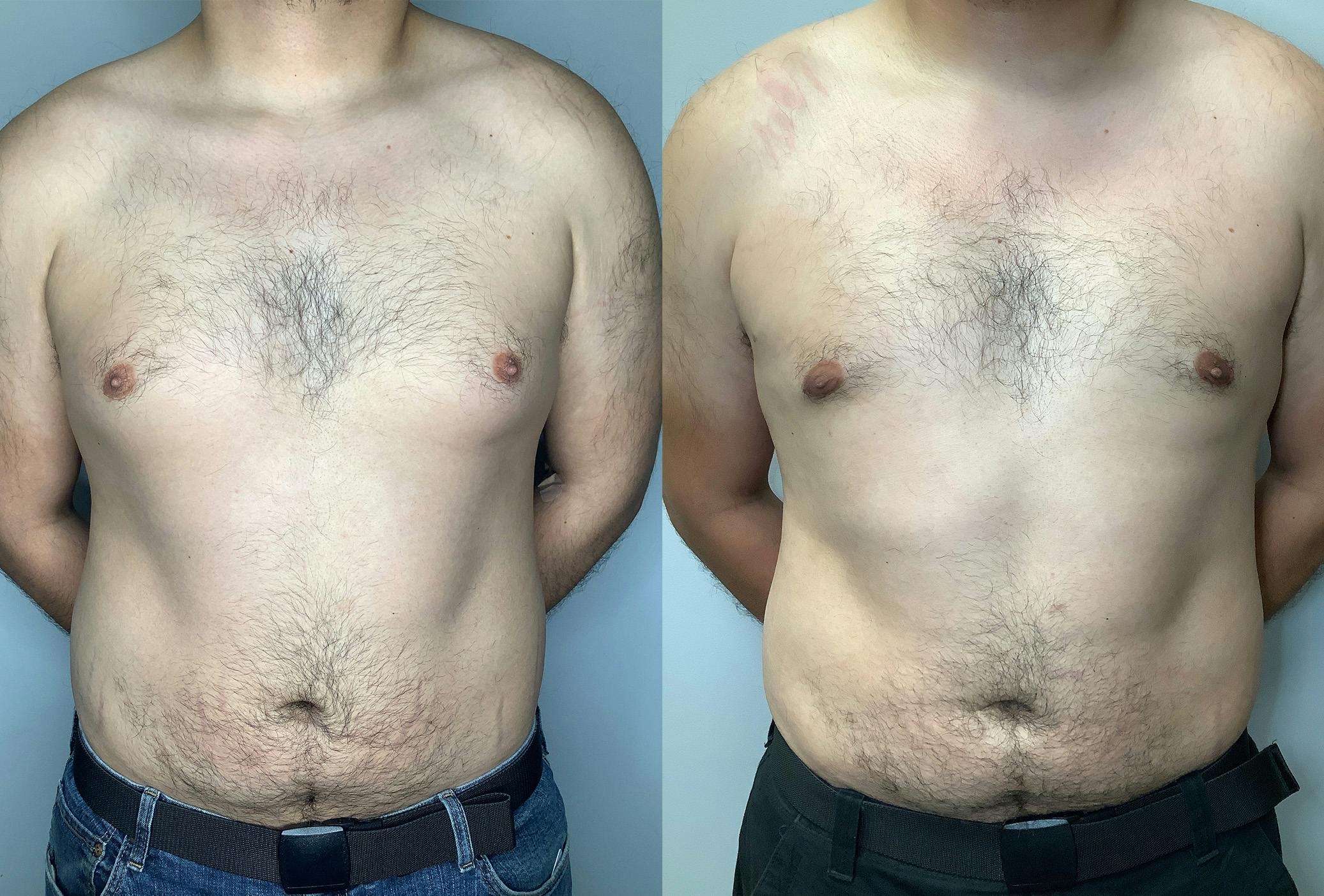 Gynecomastia Before & After Gallery - Patient 122931865 - Image 1