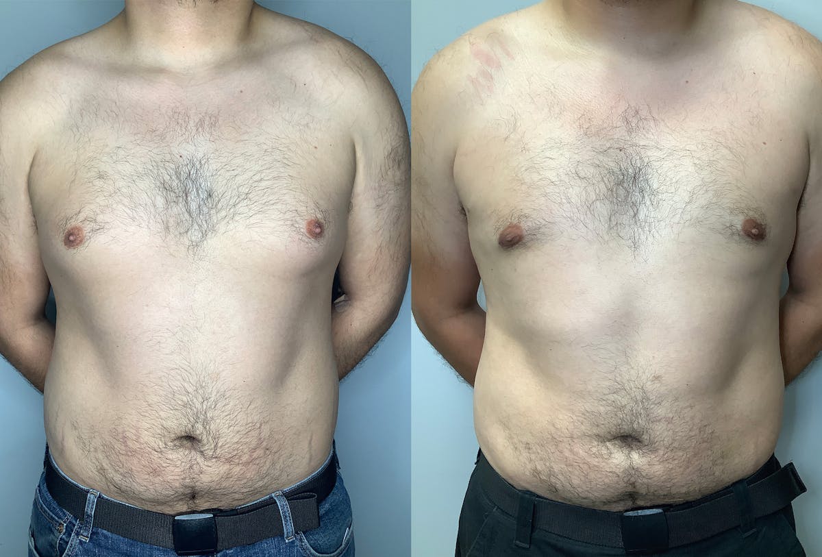 Gynecomastia Before & After Gallery - Patient 122931865 - Image 1