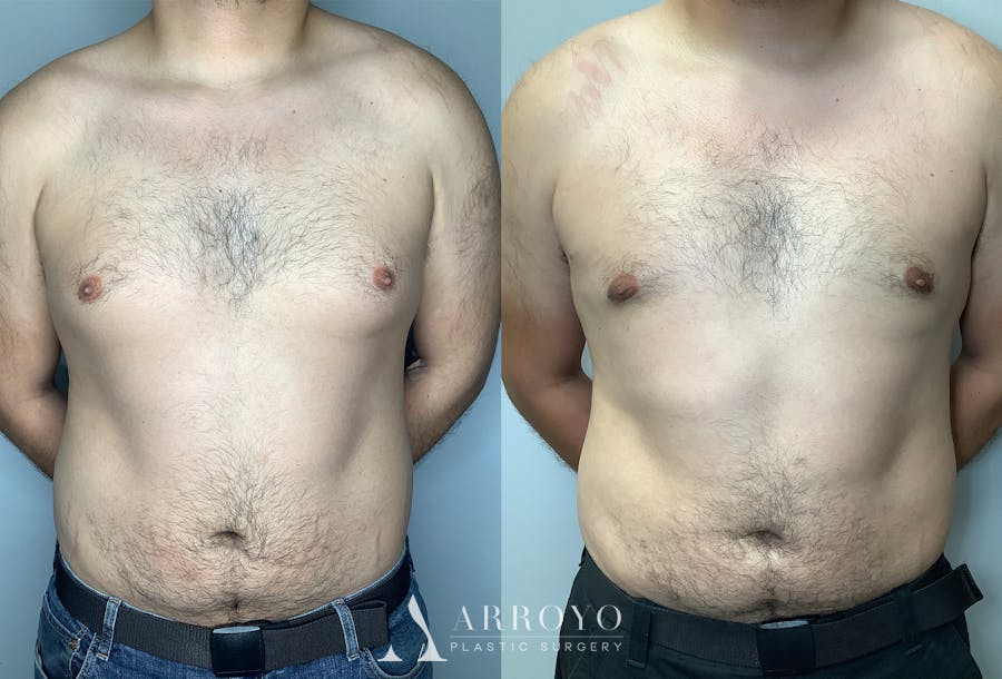 Gynecomastia Before & After Gallery - Patient 122931865 - Image 1