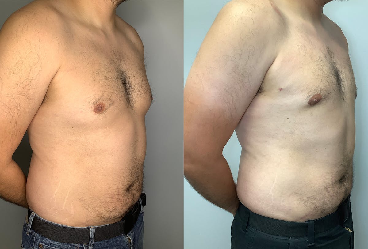 Gynecomastia Before & After Gallery - Patient 122931865 - Image 2